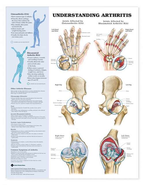 Understanding Arthritis Understanding Arthritis