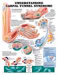 Understanding Carpal Tunnel Syndrome