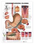 Understanding Ulcers
