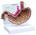 Stomach with Ulcers Model
