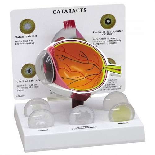 Cataract Eye Model