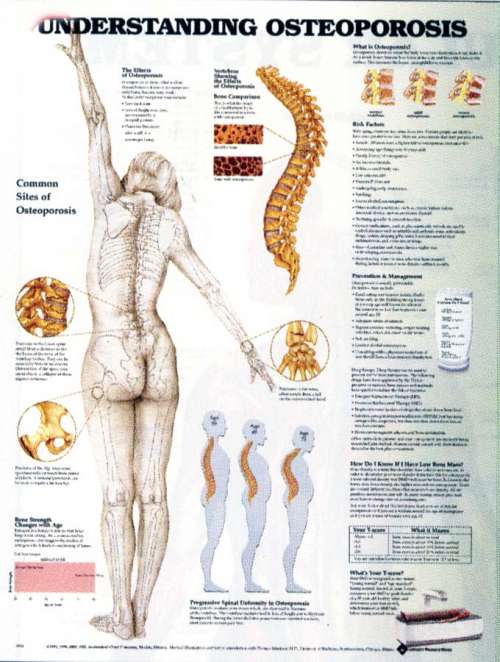 Understanding Osteoporosis