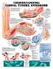 Understanding Carpal Tunnel Syndrome