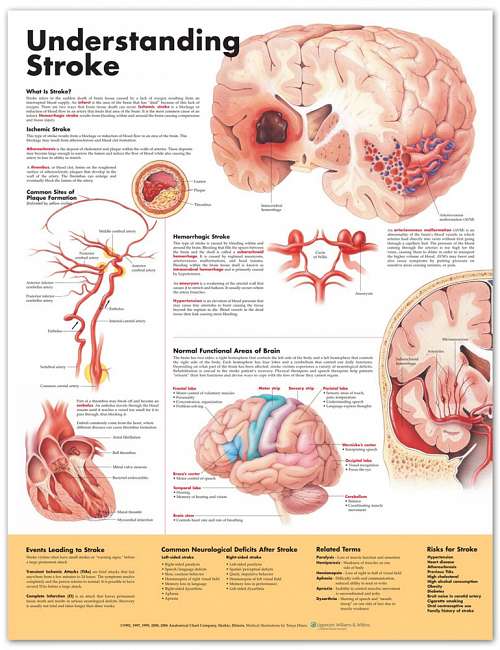 Understanding Stroke