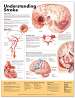 Understanding Stroke