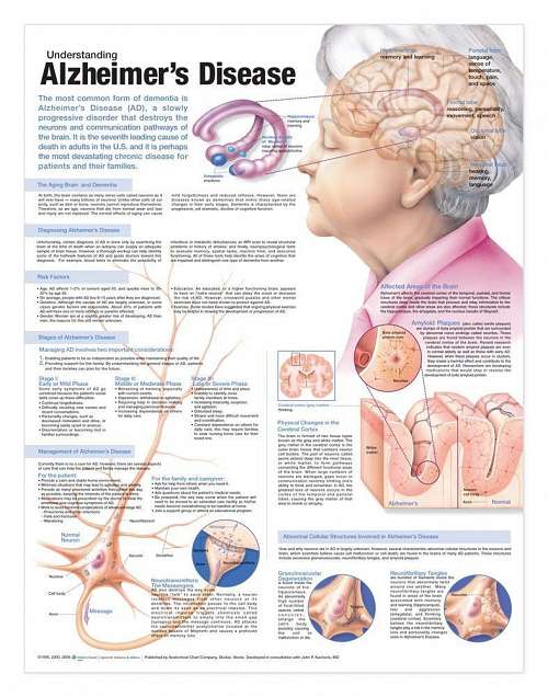 Understanding Alzheimer
