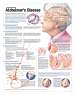 Understanding Alzheimer's