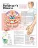 Understanding Parkinson's Disease