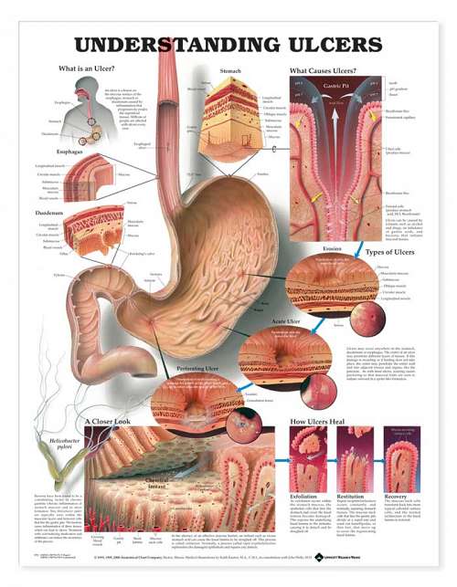 Understanding Ulcers