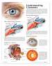 Understanding Glaucoma