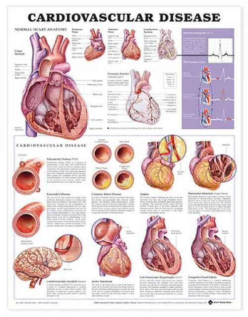 Cardiovascular Disease Anatomical Chart