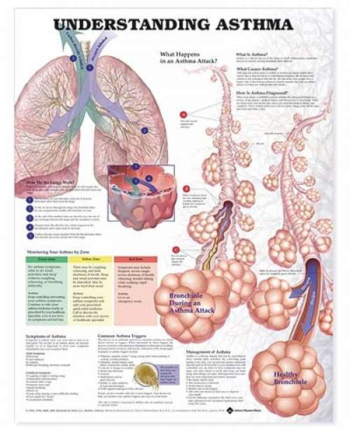 Understanding Asthma Anatomical Chart 2nd Edition