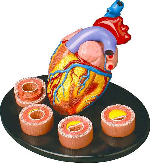 Heart Conditions Model